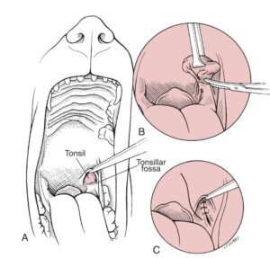 tonsilotomy